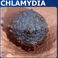 10 bệnh thường gặp do Chlamydia biến chứng gây ra